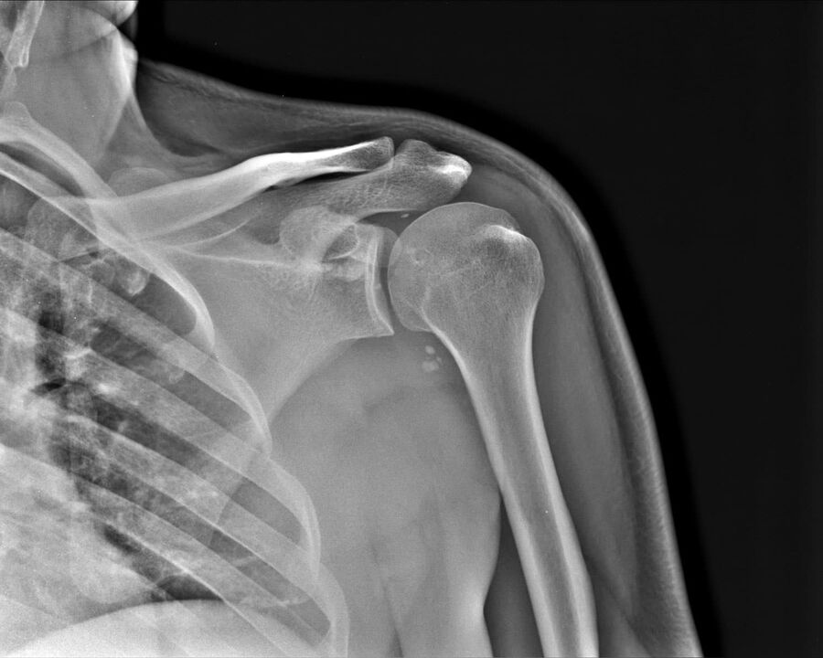 Radiography of arthrosis of the shoulder joint of the 2nd degree
