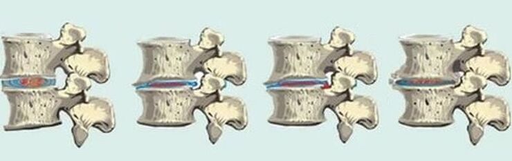 spinal cord injury in case of thoracic osteochondrosis