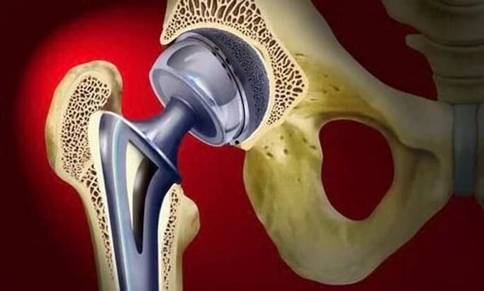 replacement of the hip joint for osteoarthritis