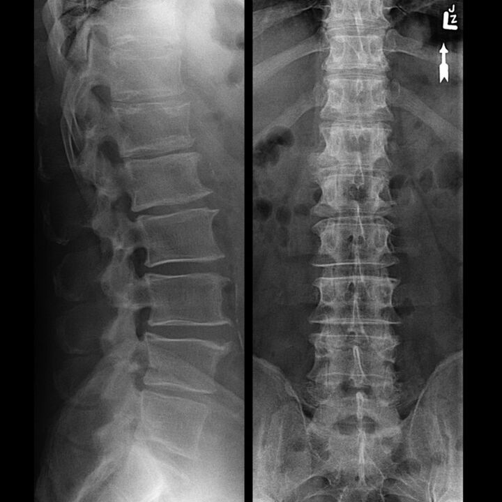 X-ray of the thoracic region showing a decrease in the space between the vertebrae along the spine from bottom to top