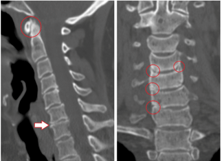 CT shows damaged vertebrae and discs of heterogeneous height due to thoracic osteochondrosis. 