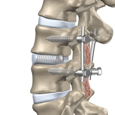 Replacement of the destroyed disc of the thoracic spine with an artificial implant