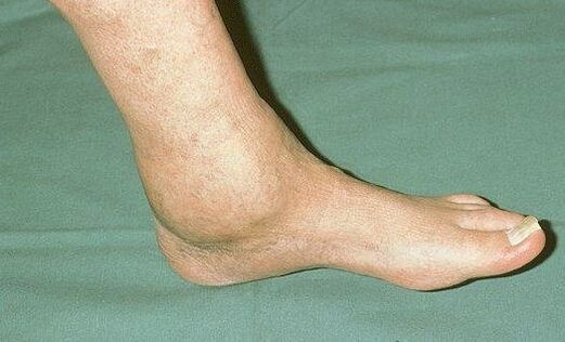 swelling of the ankle with osteoarthritis