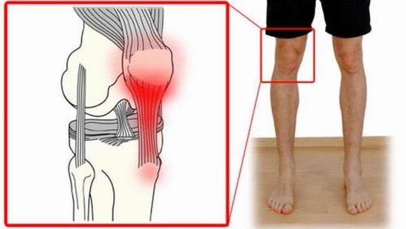 joint damage in shoulder arthrosis