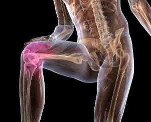 Inflammation of the knee joint with osteoarthritis