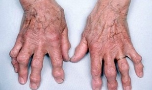 How to distinguish arthritis of the fingers from osteoarthritis