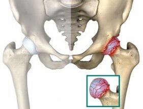 causes of atrophy of the hip joint