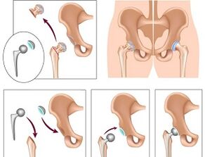 endoprosthetics for arthrosis of the hip joint