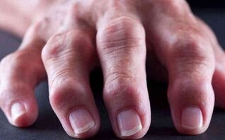 rheumatoid arthritis, as a cause of joint pain
